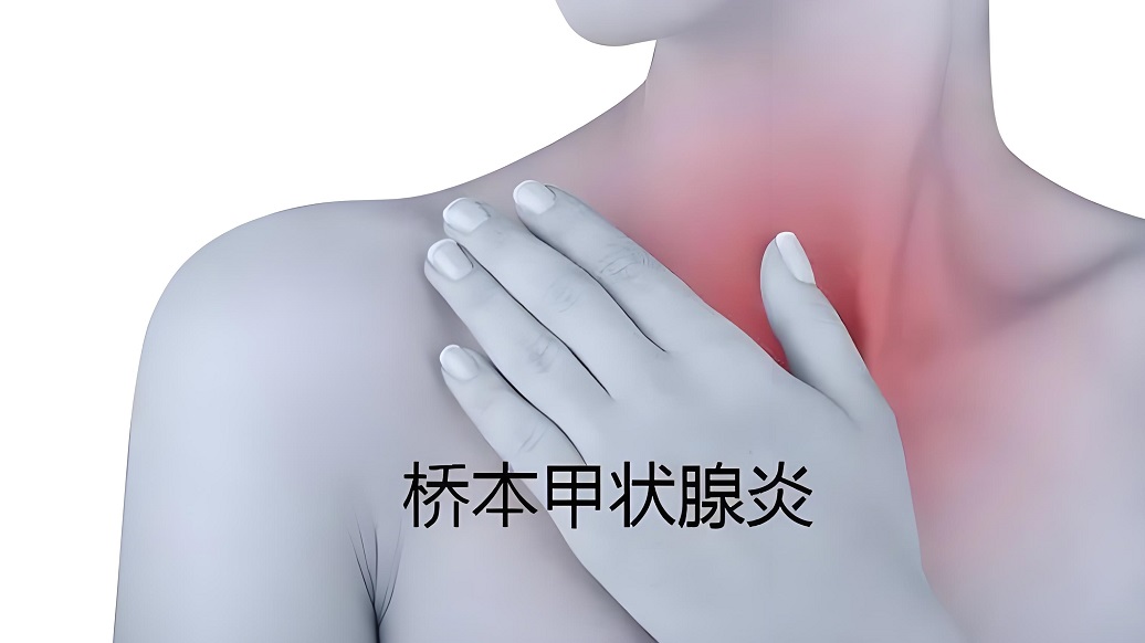 桥本甲状腺炎究竟是否需要治疗