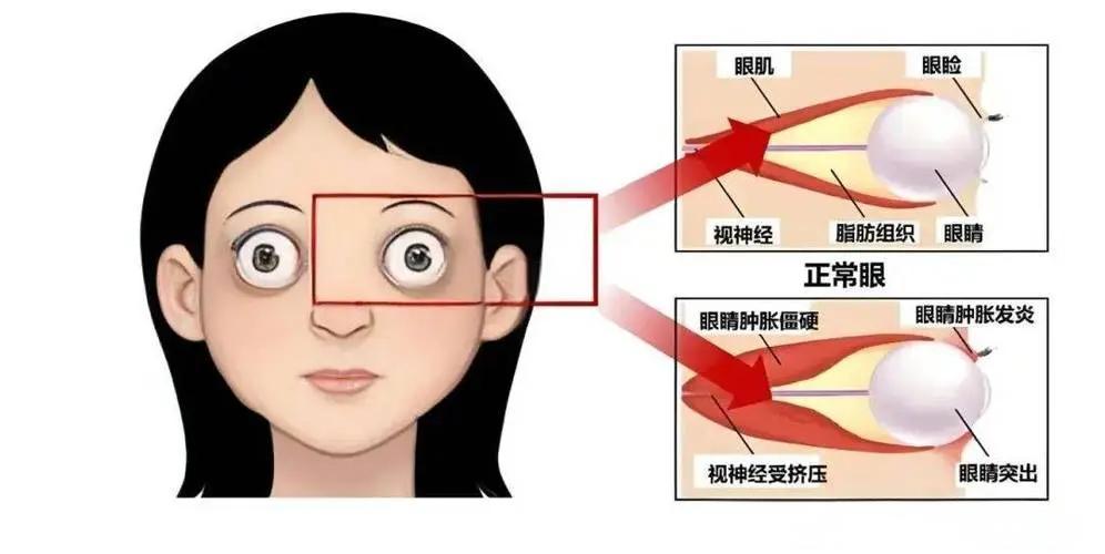 甲亢眼睛突出怎么恢复正常